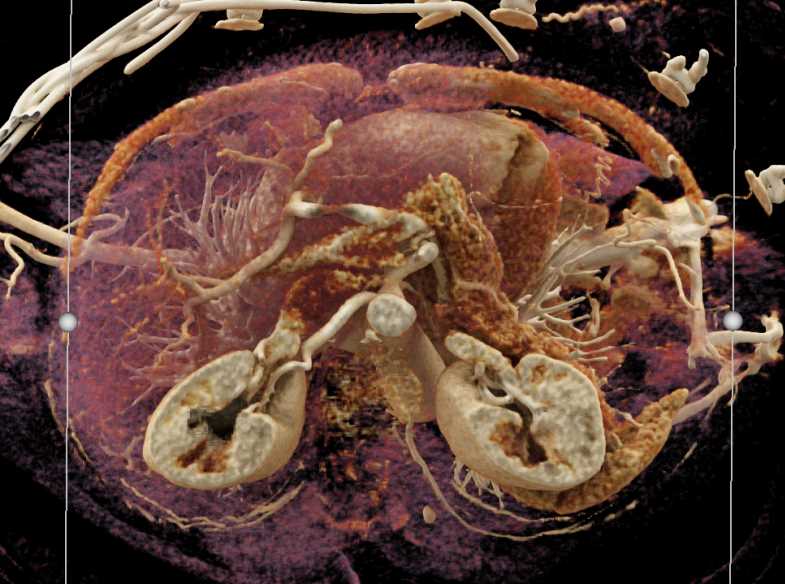 Subtle Pancreas Adenocarcinoma - CTisus CT Scan