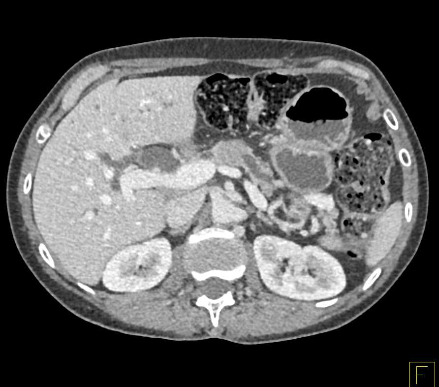 Adenocarcinoma of the Head of the Pancreas - CTisus CT Scan