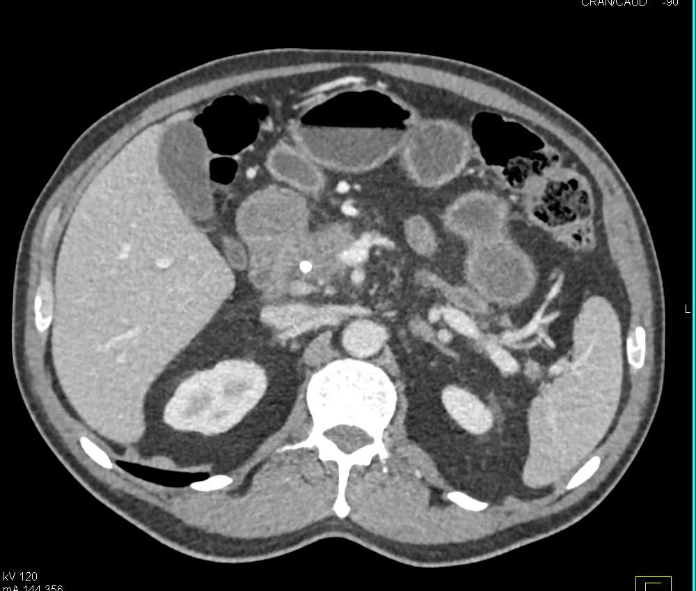 Adenocarcinoma of the Head of the Pancreas - CTisus CT Scan