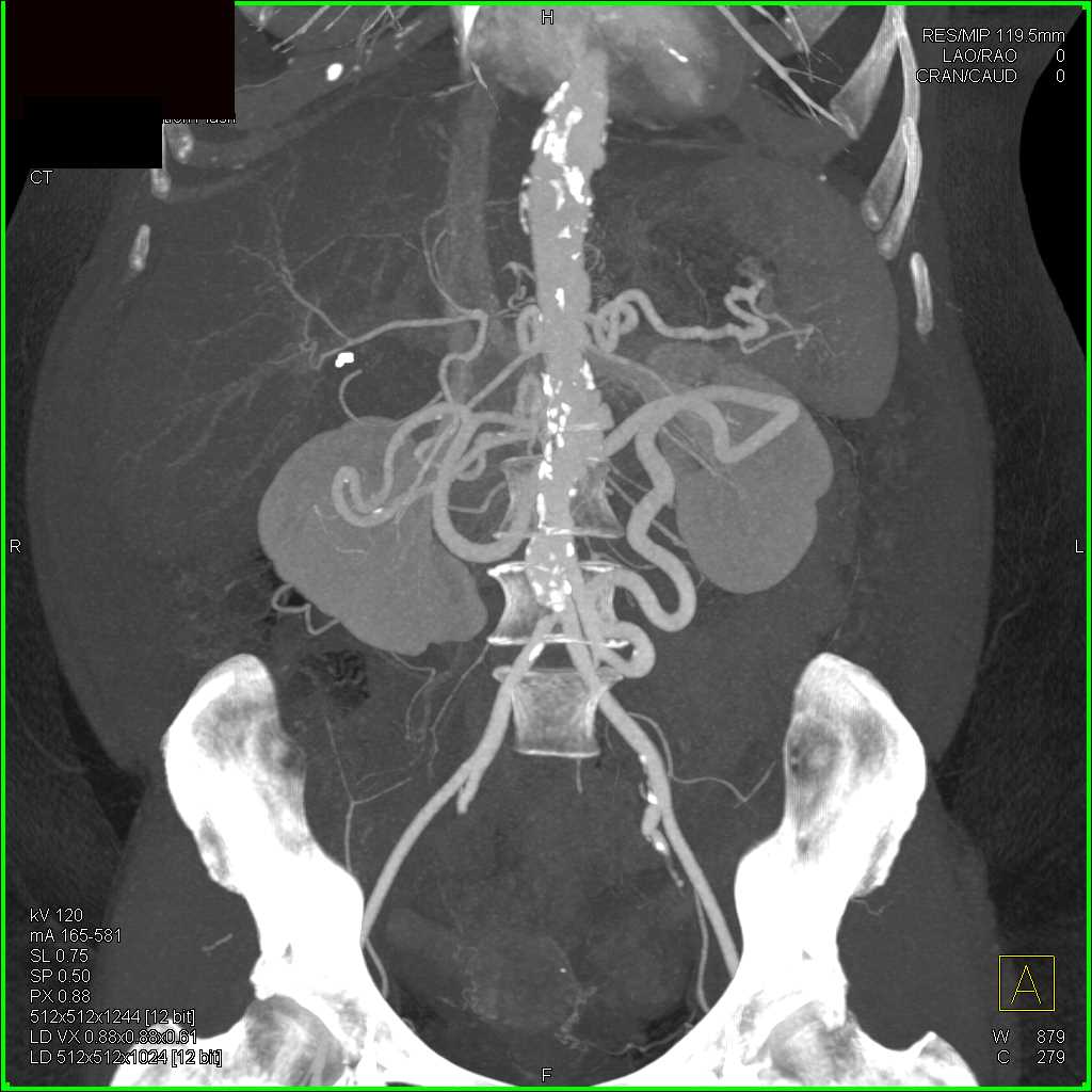 Celiac Artery Occlusion with Collaterals - CTisus CT Scan