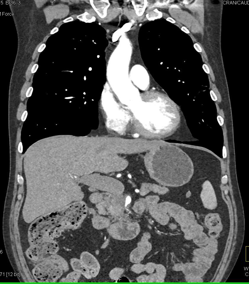 Carcinoma Body of Pancreas - CTisus CT Scan