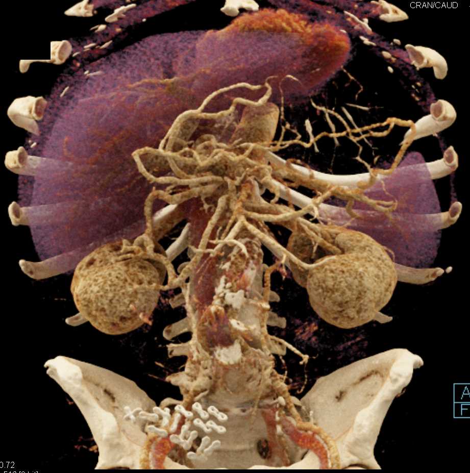 Carcinoma Body of Pancreas - CTisus CT Scan