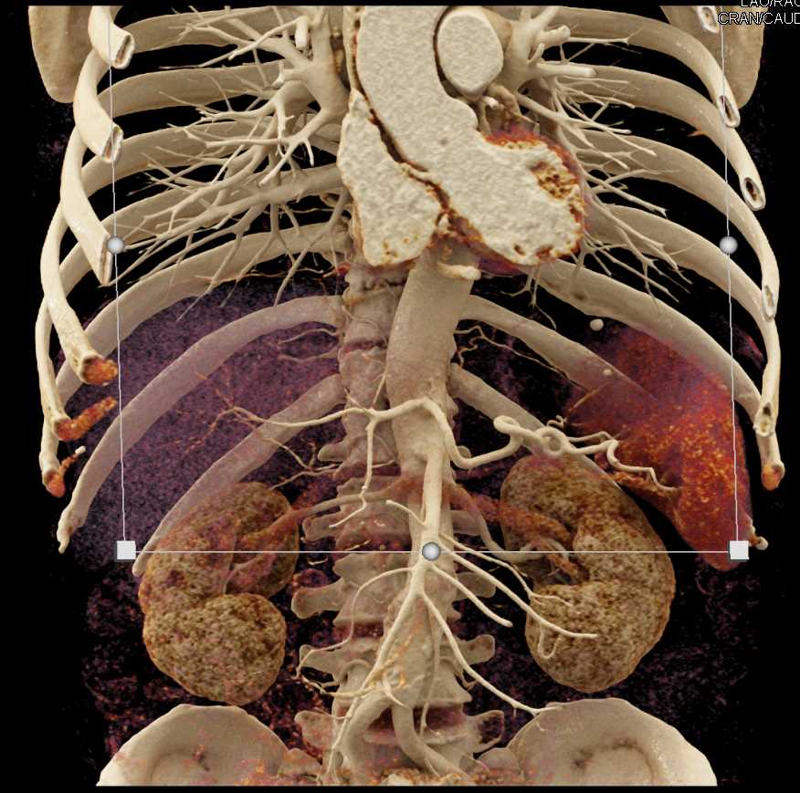 Invasive Carcinoma Head of Pancreas - CTisus CT Scan