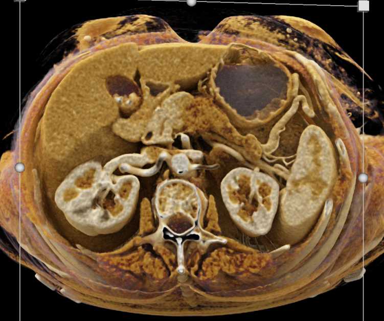 Carcinoma Body of the  Pancreas - CTisus CT Scan