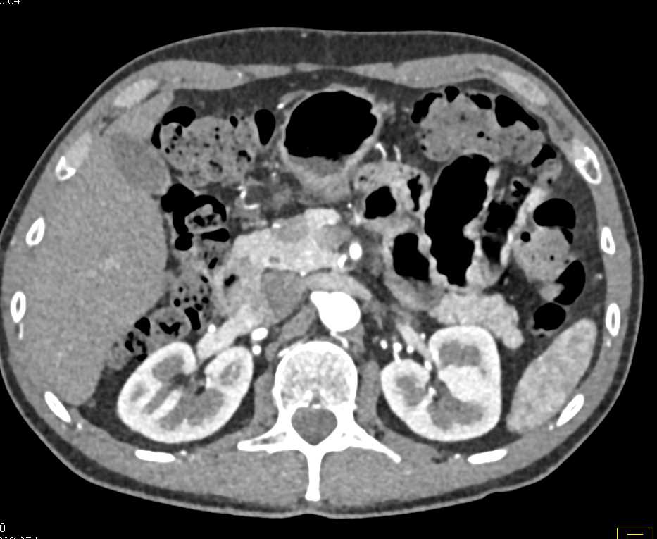 Pancreatic Neuroendocrine Tumor (PNET) in the Head of the Pancreas - CTisus CT Scan