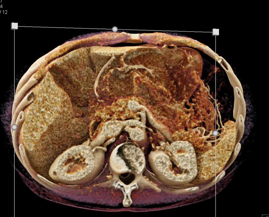 Pancreatic Neuroendocrine Tumor (PNET) in the Head of the Pancreas with Cinematic Rendering - CTisus CT Scan