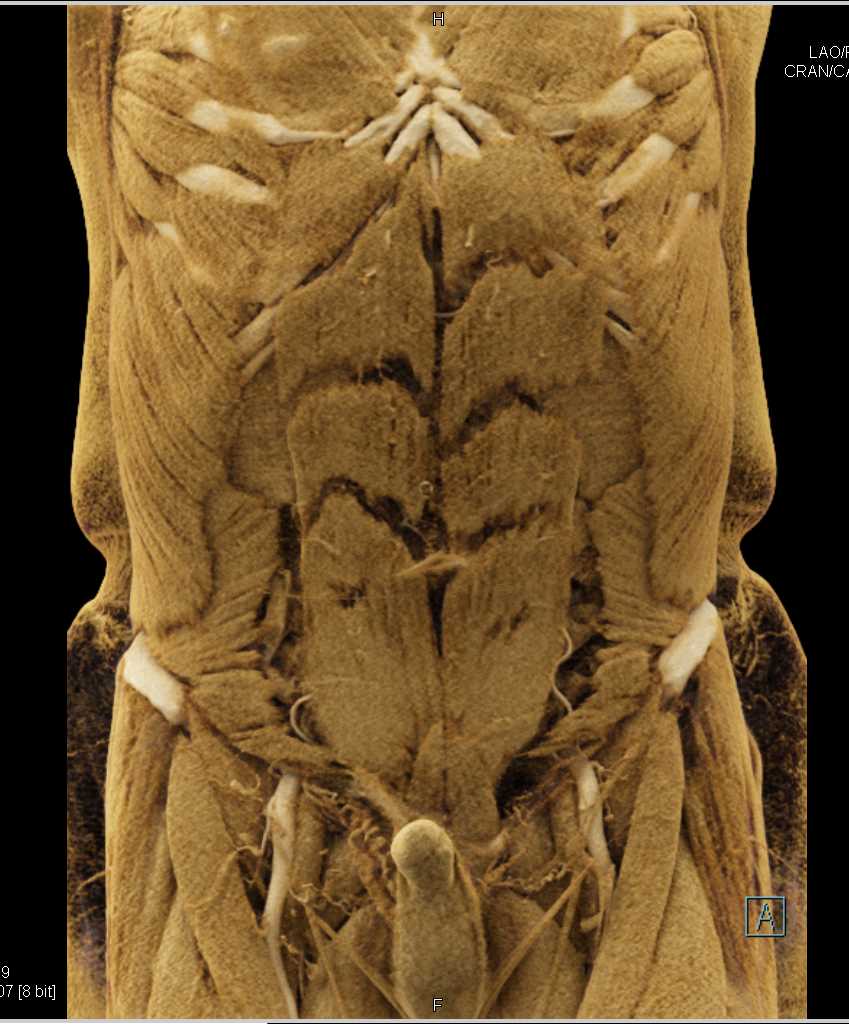 Cinematic Rendering of the Pancreas and the Mesenteric Vessels - CTisus CT Scan