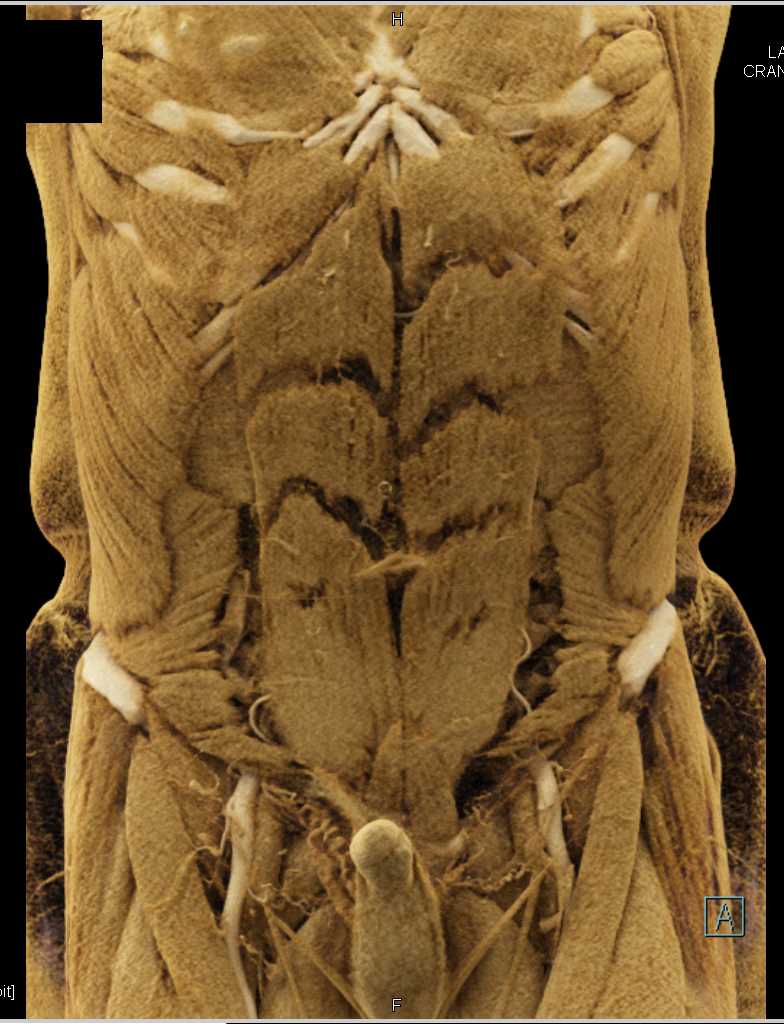 Cinematic Rendering of the Pancreas and the Mesenteric Vessels - CTisus CT Scan