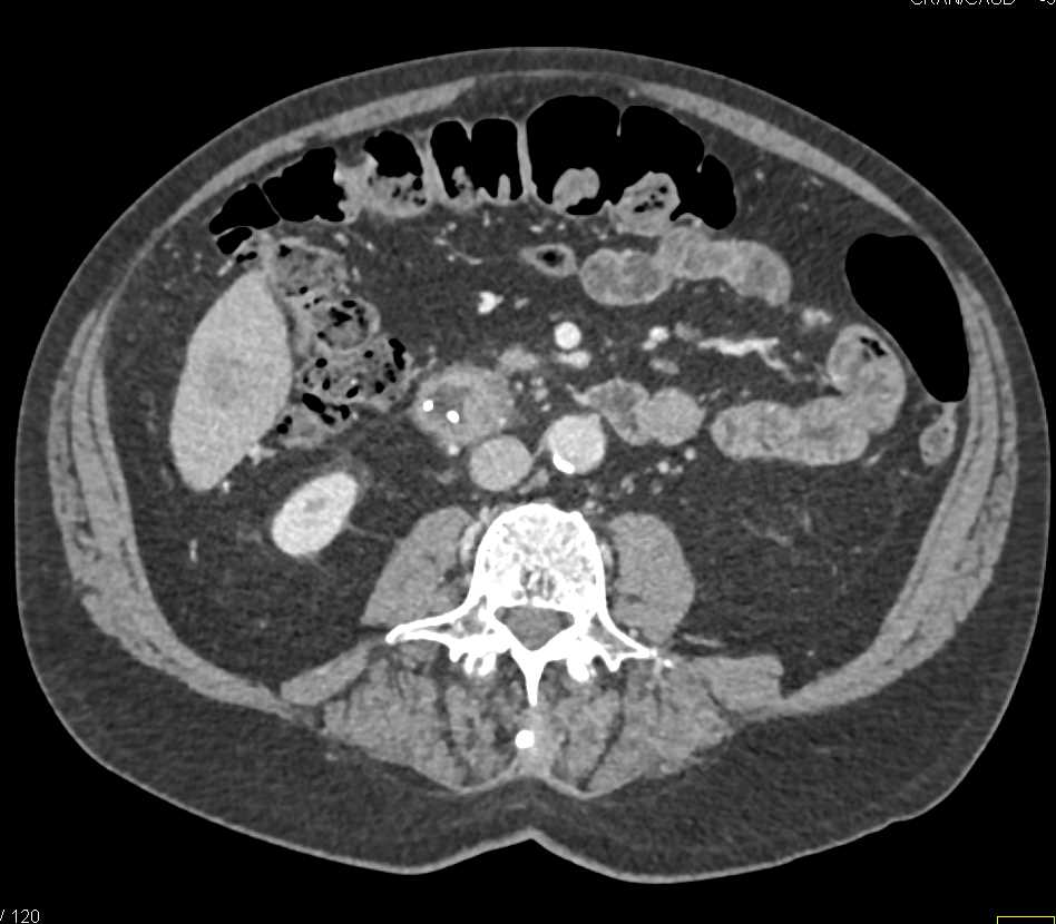 Ampullary Cancer in a Patient with Chronic Pancreatitis - CTisus CT Scan