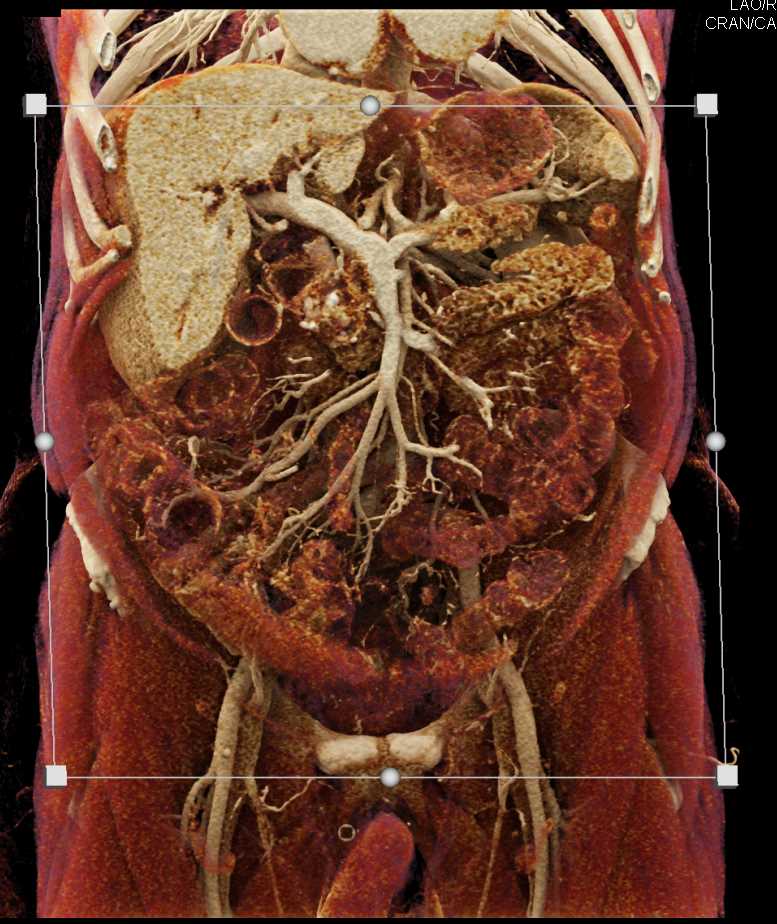 Ampullary Cancer in a Patient with Chronic Pancreatitis and Common Bile Duct (CBD) Stent with Cinematic Rendering - CTisus CT Scan