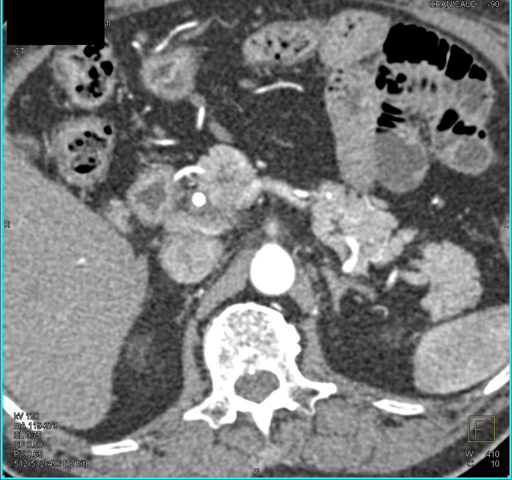 Cystic Pancreatic Neuroendocrine Tumor (PNET) Body of the Pancreas - CTisus CT Scan