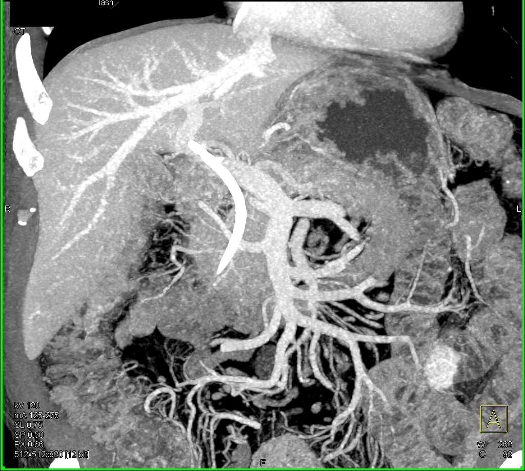 Cystic Pancreatic Neuroendocrine Tumor (PNET) Body of the Pancreas - CTisus CT Scan