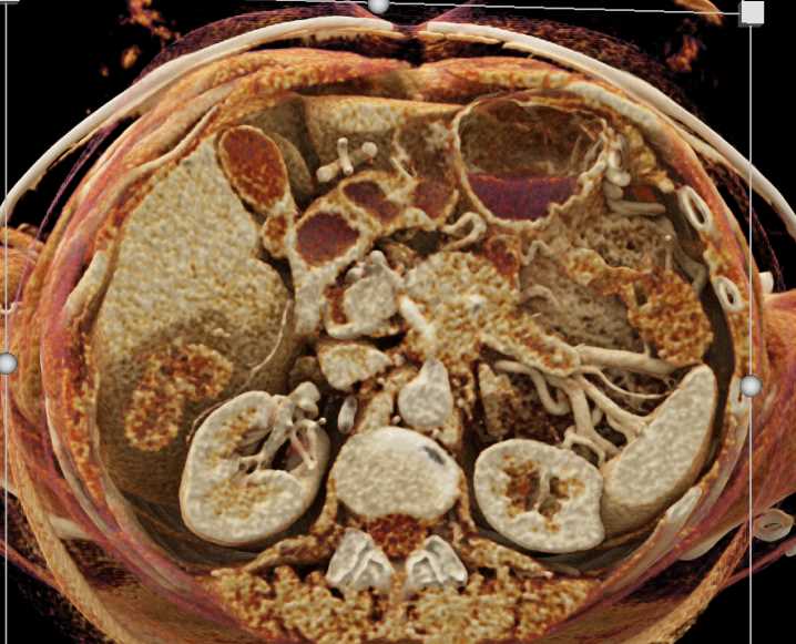 Pancreatic Adenocarcinoma Encases the Celiac and the Superior Mesenteric Artery (SMA) with Cinematic Rendering - CTisus CT Scan