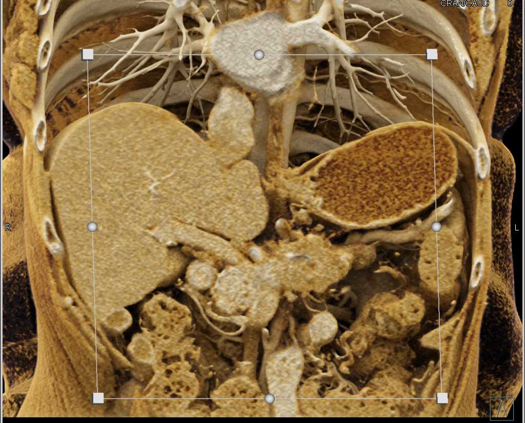 Pancreatic Adenocarcinoma Encases the Celiac and the Superior Mesenteric Artery (SMA) with Cinematic Rendering - CTisus CT Scan