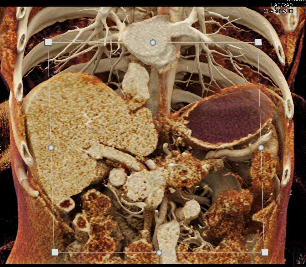 Pancreatic Adenocarcinoma Encases the Portal Vein (PV) and Occludes the Splenic Vein with Cinematic Rendering - CTisus CT Scan
