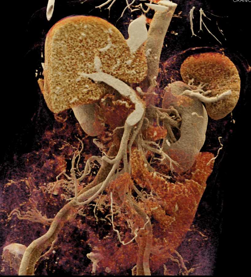 Pancreatic Adenocarcinoma Encases the Portal Vein (PV) and Occludes the Splenic Vein with Cinematic Rendering - CTisus CT Scan