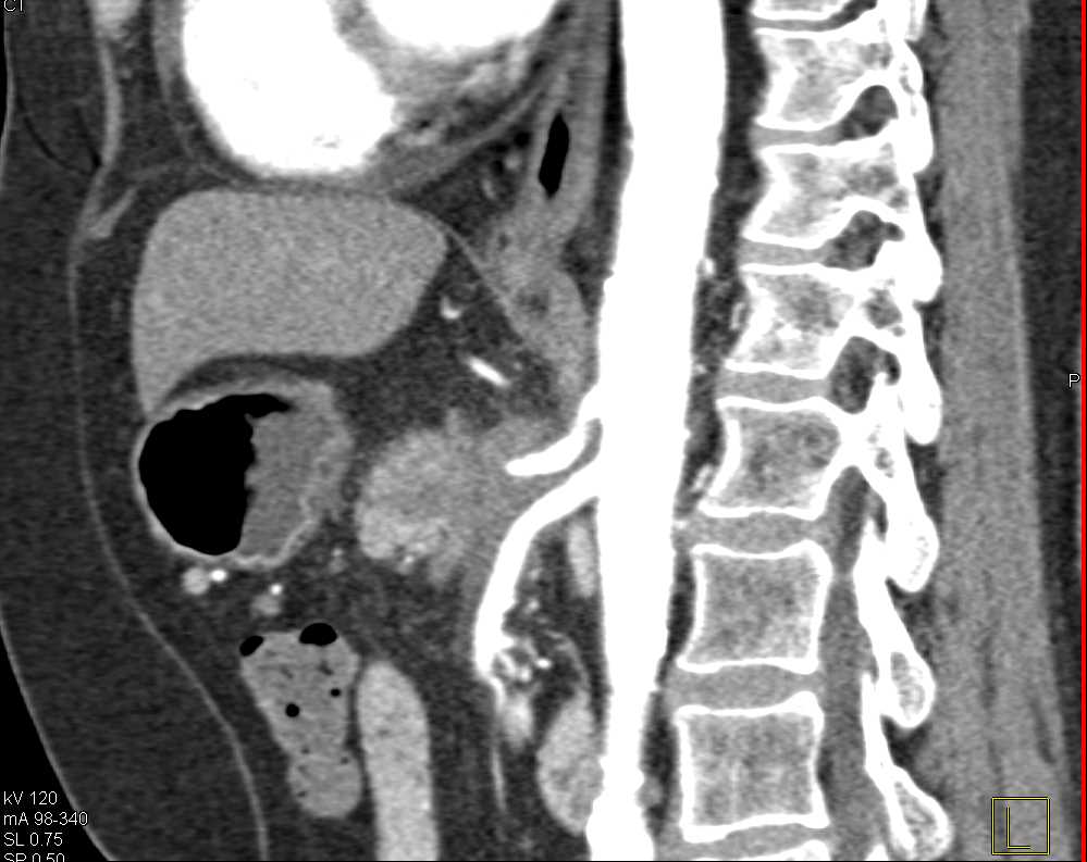 Adenocarcinoma Pancreas with Vessel Encasement - CTisus CT Scan
