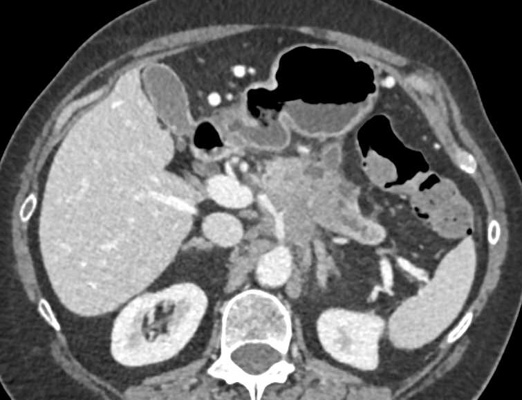 Adenocarcinoma Pancreas with Vessel Encasement - CTisus CT Scan