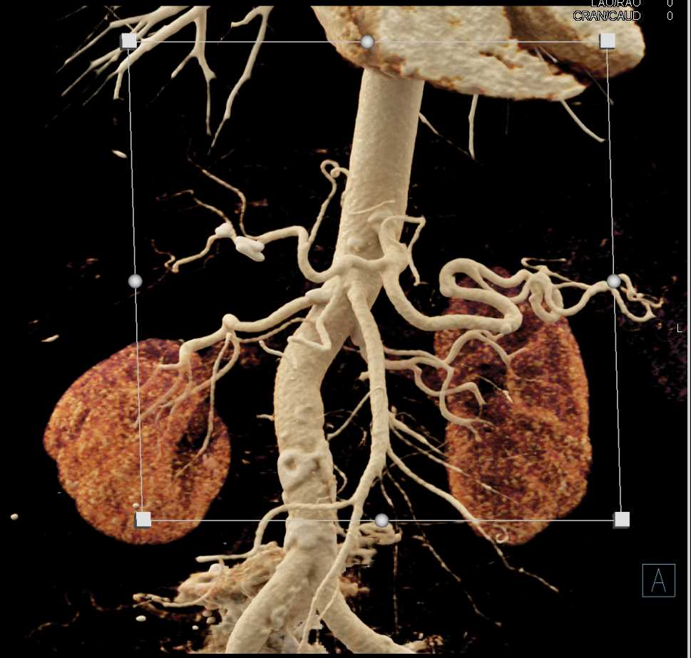 Carcinoma Tail of Pancreas with Vascular Incasement - CTisus CT Scan