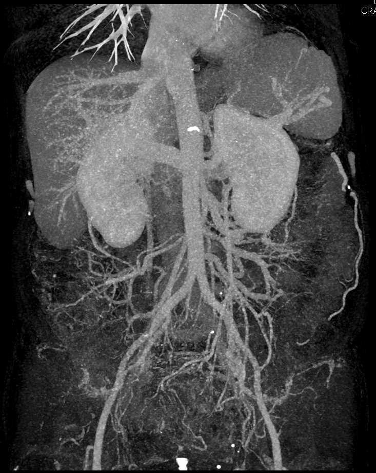 Pancreatic Cancer - CTisus CT Scan