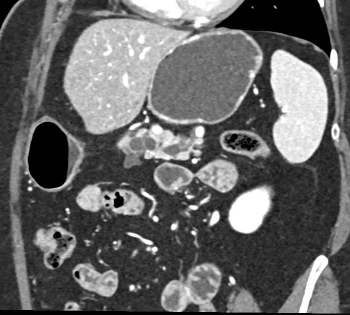 Mixed Type Pancreas Intraductal Papillary Mucinous Neoplasms (IPMNs) - CTisus CT Scan