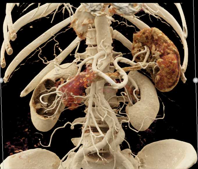 Mixed Type Pancreas Intraductal Papillary Mucinous Neoplasms (IPMNs) - CTisus CT Scan