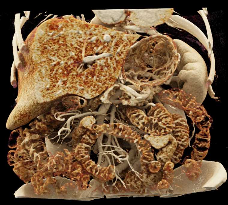 Mixed Type Pancreas Intraductal Papillary Mucinous Neoplasms (IPMNs) - CTisus CT Scan