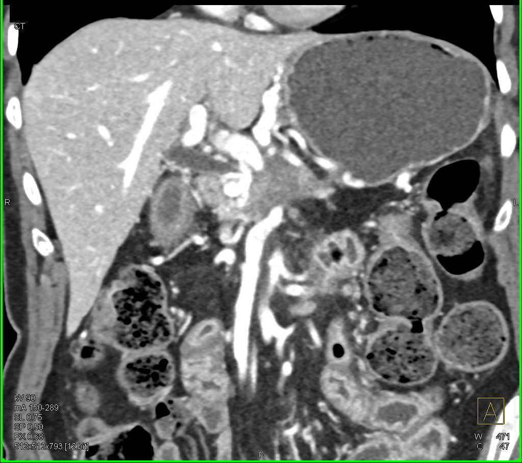 Pancreatic Adenocarcinoma with Arterial and Venous Involvement - CTisus CT Scan