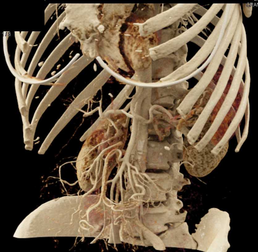 Subtle Carcinoma Body of the Pancreas - CTisus CT Scan