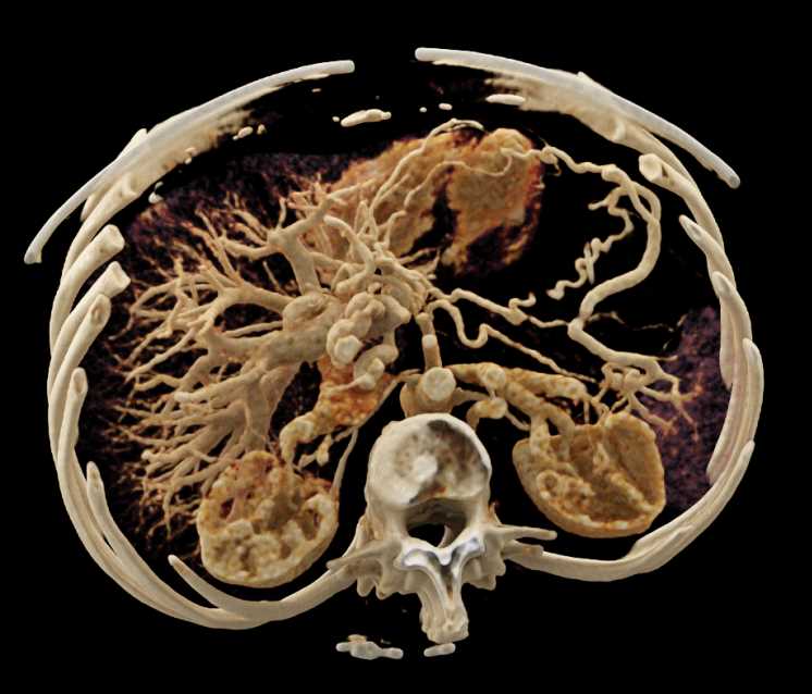 Pancreatic Cancer - CTisus CT Scan