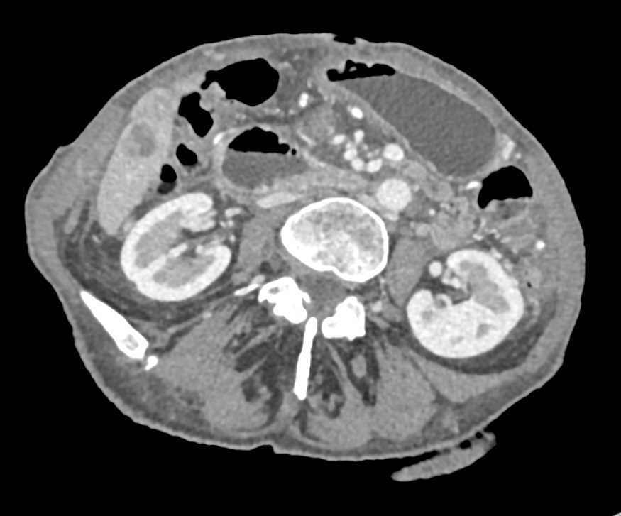 Pancreatic Cancer with Liver Metastases - CTisus CT Scan