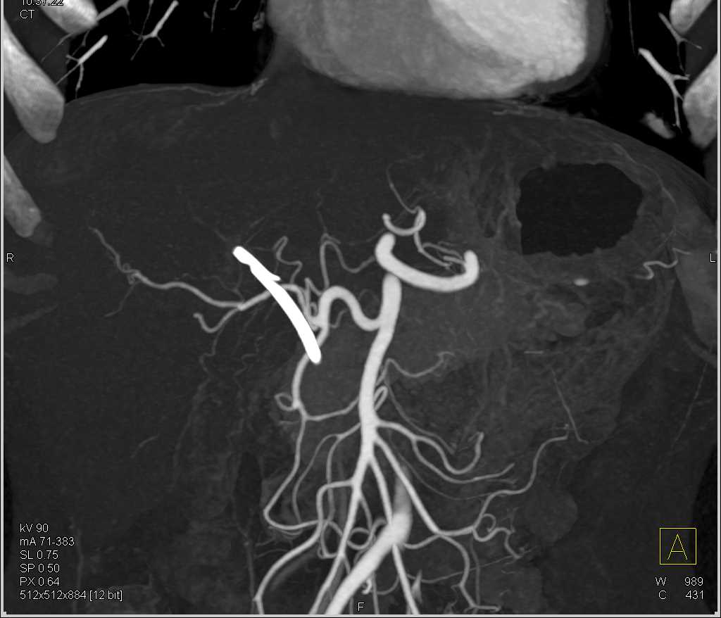 Pancreatic Cancer with Liver Metastases - CTisus CT Scan