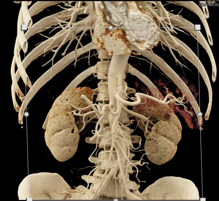 Pancreas Cancer with Common Bile Duct (CBD) Stent with Cinematic Rendering - CTisus CT Scan