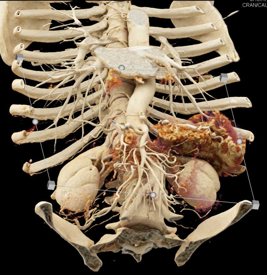 Pancreas Cancer with Common Bile Duct (CBD) Stent with Cinematic Rendering - CTisus CT Scan