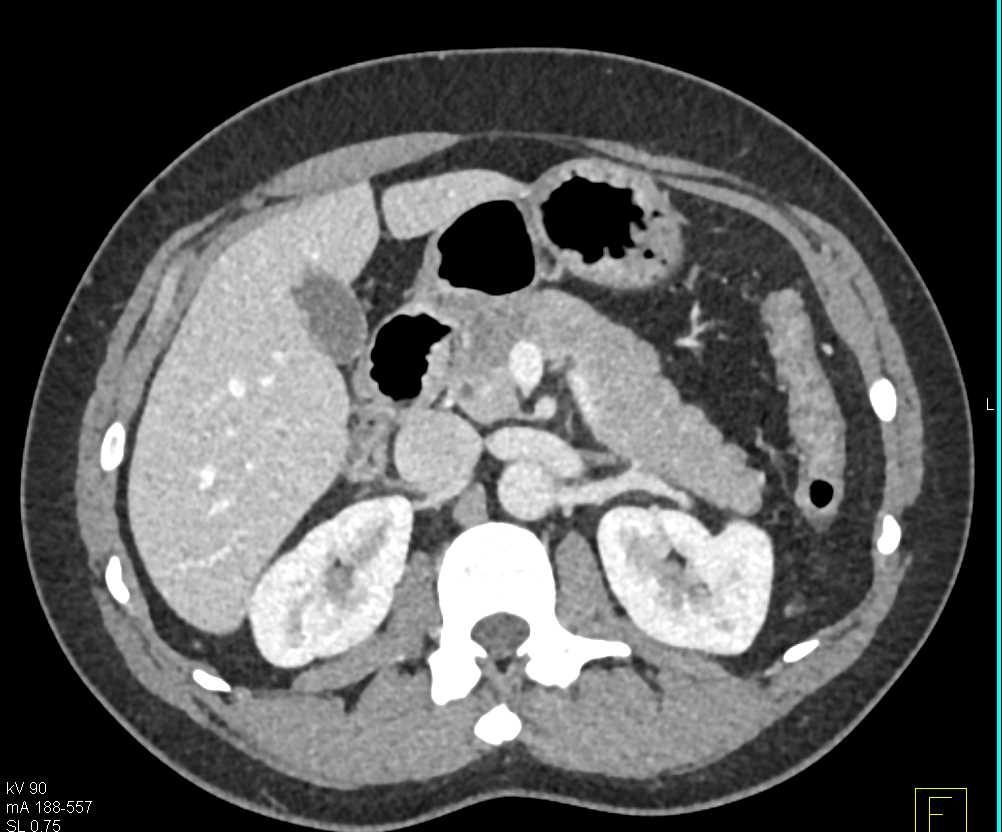 Subtle Carcinoma Head of Pancreas - CTisus CT Scan