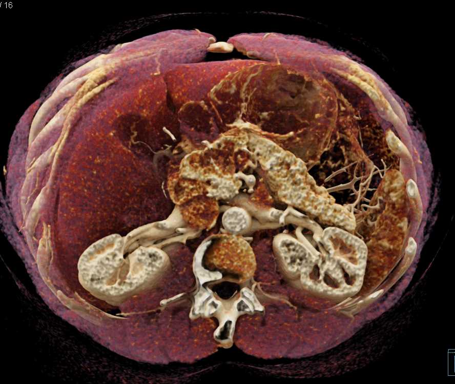 Carcinoma Head of Pancreas - CTisus CT Scan