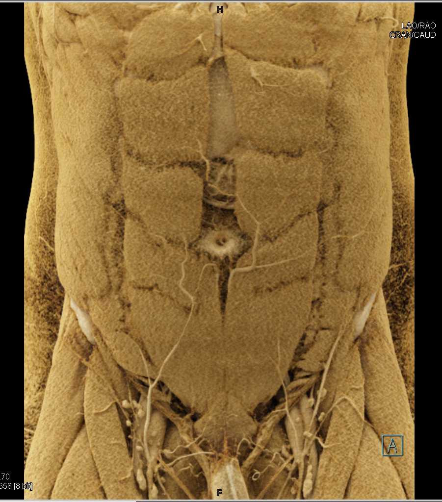 Carcinoma Head of Pancreas - CTisus CT Scan