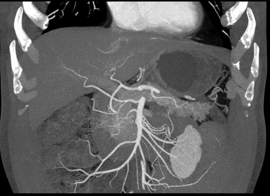 1cm Pancreatic Neuroendocrine Tumor (PNET) Head of Pancreas - CTisus CT Scan