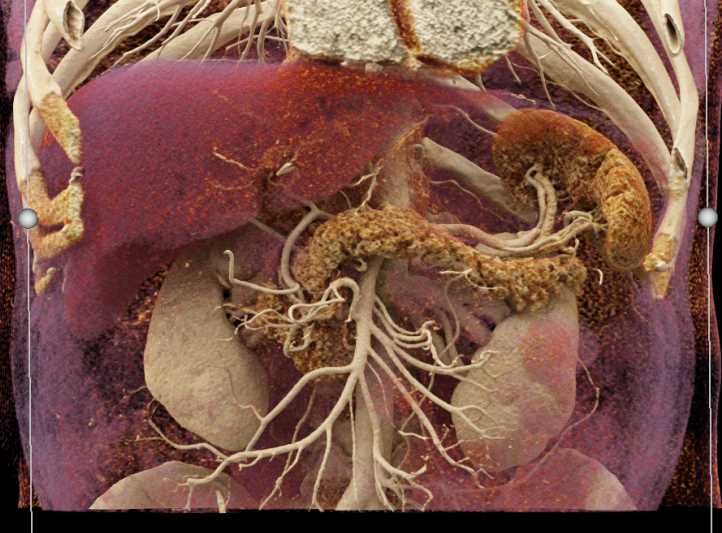 Cinematic Rendering of the Normal Pancreas - CTisus CT Scan