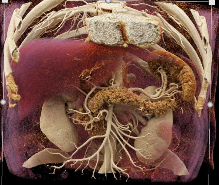 Cinematic Rendering of the Normal Pancreas - CTisus CT Scan