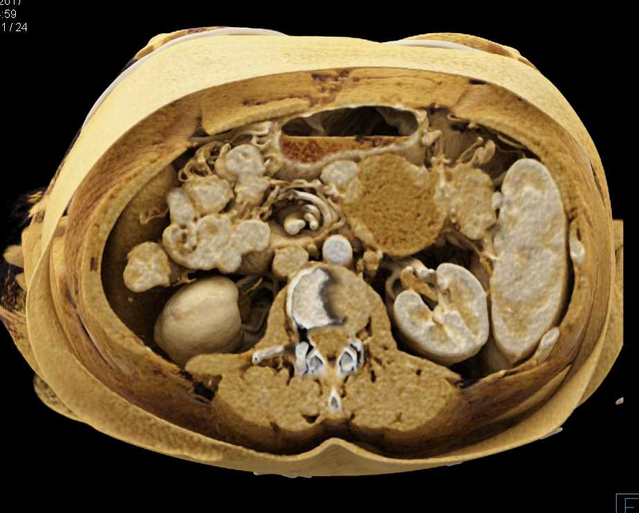 Vascular Mapping of Pancreas Adenocarcinoma with Cinematic Rendering - CTisus CT Scan