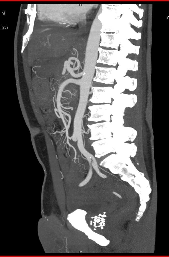 Autoimmune Pancreatitis - CTisus CT Scan