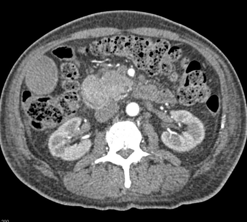 Autoimmune Pancreatitis - CTisus CT Scan