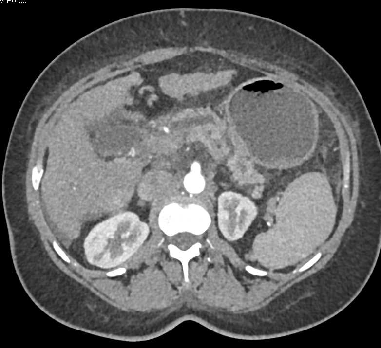 Carcinoma Head of Pancreas with the Double Duct Sign - CTisus CT Scan