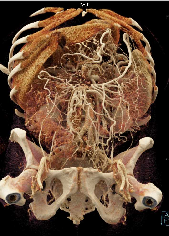 Portal Vein and Superior Mesenteric Vein (SMV) Encasement by Pancreatic Cancer - CTisus CT Scan