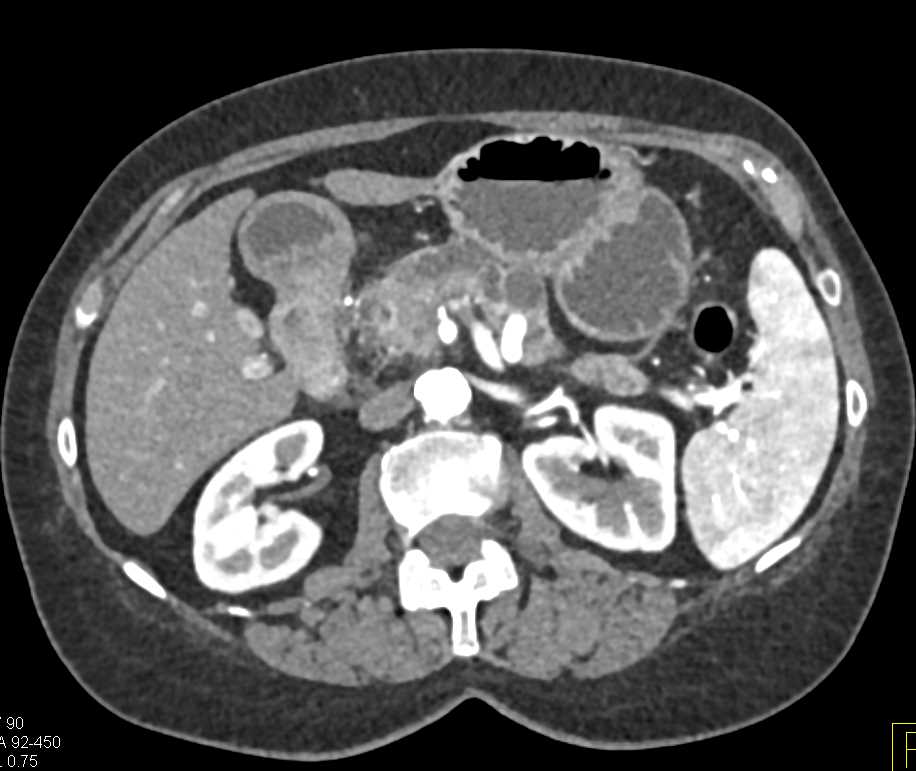 Pancreatic Cancer Obstructs the Pancreatic Duct - CTisus CT Scan