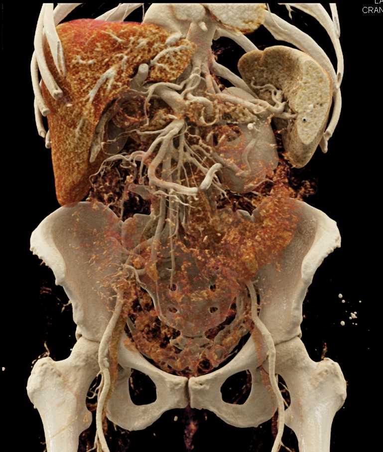 Intraductal Papillary Mucinous Neoplasm (IPMN) Body of Pancreas - CTisus CT Scan