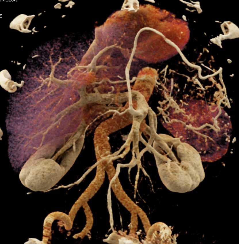 Carcinoma Tail of Pancreas with Vascular Infiltration - CTisus CT Scan