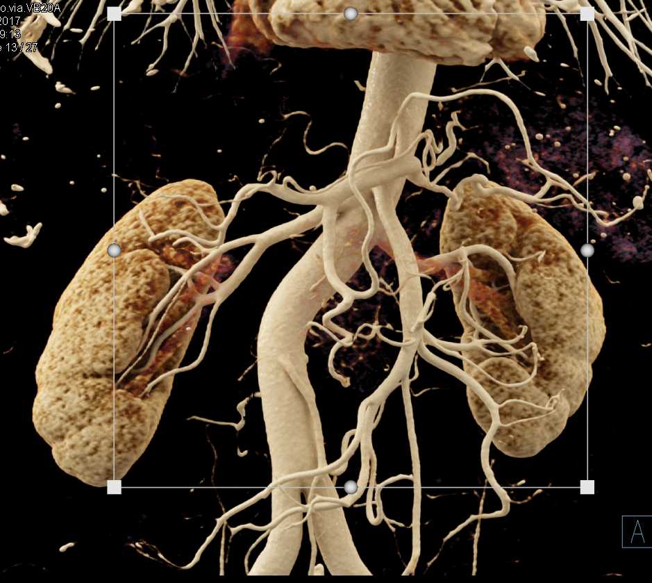 Pancreatic Cancer with Cinematic Rendering - CTisus CT Scan