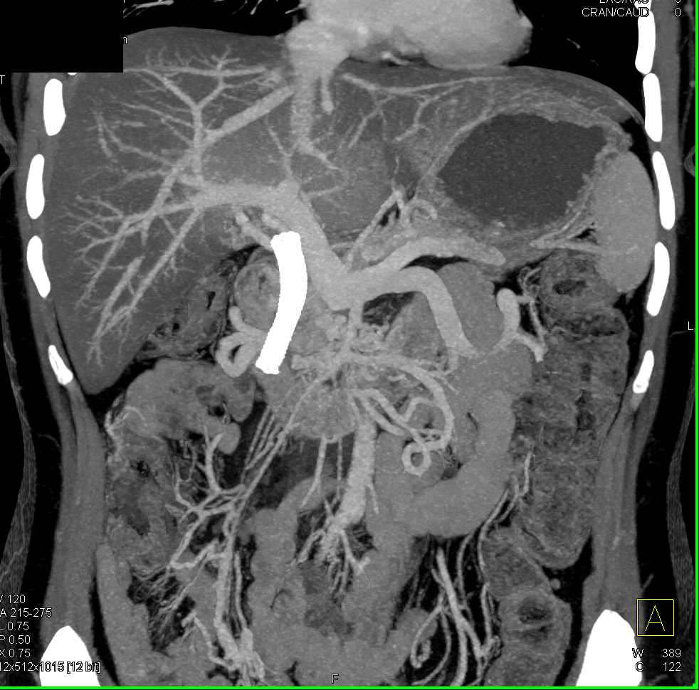 Carcinoma Head of Pancreas with Arterial and Venous Encasement - CTisus CT Scan